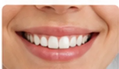 Dental Bonding