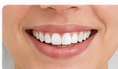 Gum Contouring