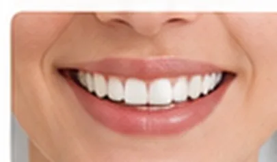 Enamel Shaping